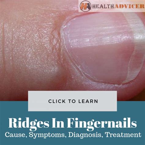 Ridges On Fingernails: Causes, Picture, Symptoms And Treatment