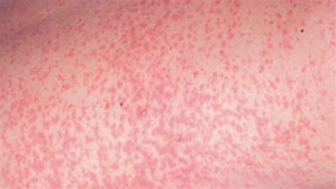 German Measles (Rubella): Causes, Symptoms, and Treatments