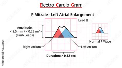 Vektorová grafika „P Wave - P Mitrale - ECG Left Atrial Enlargement ...