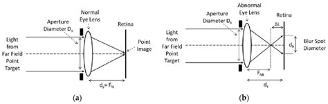 (a) Optical ray diagrams for an eye lens system having a normal eye ...