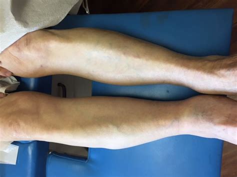 LEG SWELLING: BEFORE AND AFTER PHOTOS FOLLOWING THE PLACEMENT OF AN ...