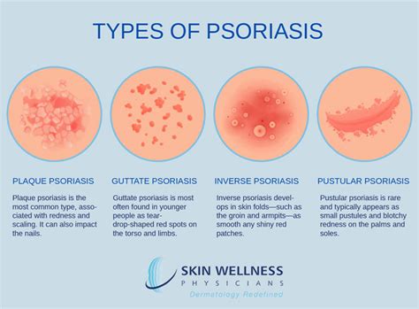 Psoriasis | Naples, FL | Skin Wellness Physicians