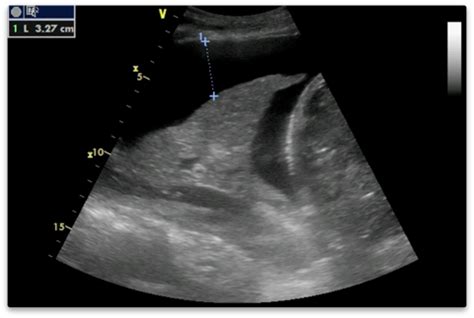 Pleural Effusion