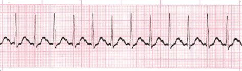 Sinus Rhythm ECGs