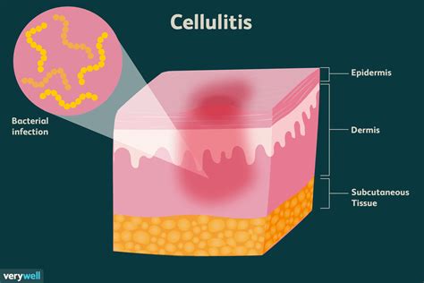 Cellulitis: Symptoms, Treatment, and More