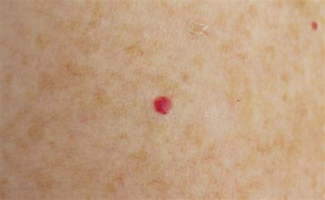 Cherry angioma tiny pinpoint red dots on skin - koguide