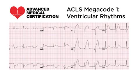 ACLS Megacode - Ventricular Rhythms