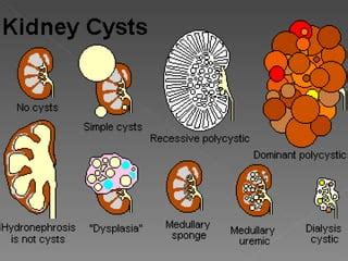 Cystic disease of the kidney | PPT