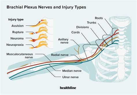 Brachial Plexus Injury: Types, Signs, and Treatment