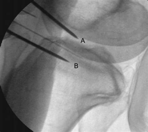 Cincinnati Knee Pain Treatment | Use Cells Not Pills | StemCures