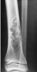 ON - RADIOLOGY: Fibrous cortical defect