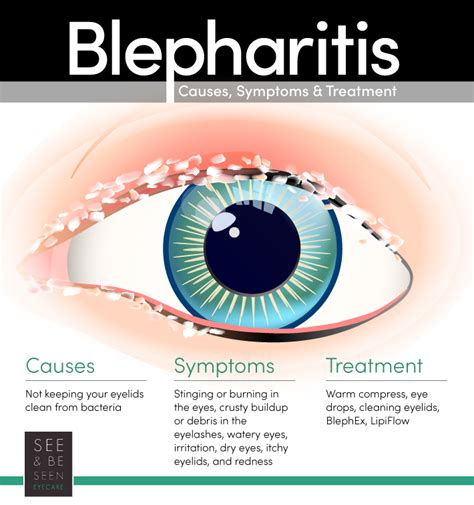 What is Blepharitis? [Causes, Treatment, & More] | Toronto