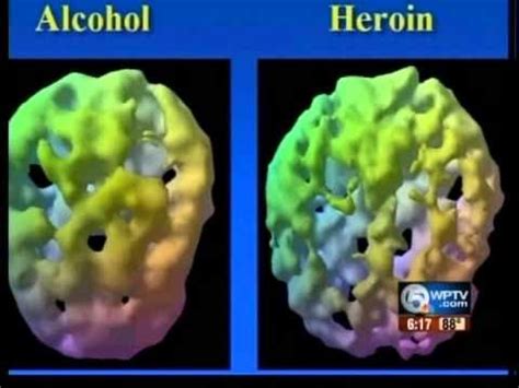 Brain scans helping fight addiction - YouTube