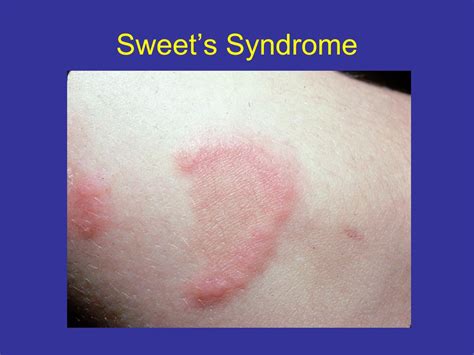 PPT - Sweet’s Syndrome PowerPoint Presentation, free download - ID:6015788