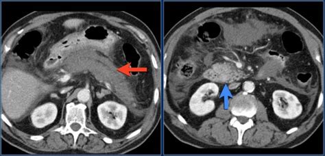 The Radiology Assistant : CT contrast injection and protocols