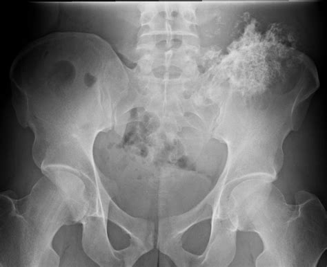 Chondrosarcoma Cases and Medical Insights | Figure 1