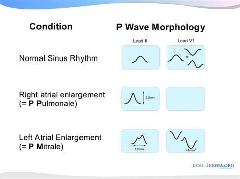 Pathological Q Wave