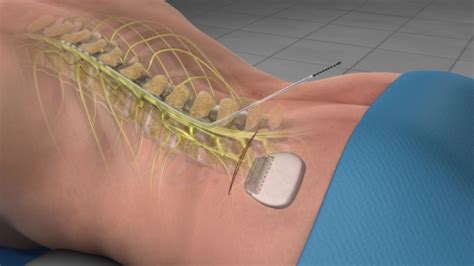 Defeating Pain with Neurostimulation - Colorado Pain Care