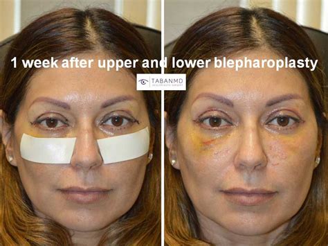 Upper Blepharoplasty Beverly Hills | Eyelid Lift Los Angeles