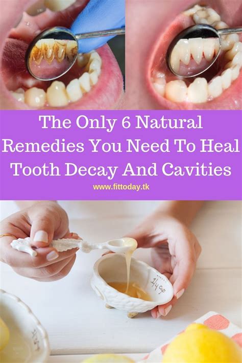 The Only 6 Natural Remedies You Need To Heal Tooth Decay And Cavities # ...