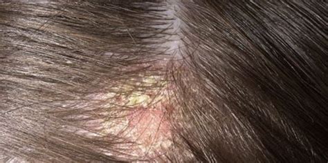 How to treat scalp scabs - Kelture Aveda | Singapore Leading Hair Salon