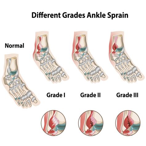 The Three Degrees (types) of Ankle Sprains