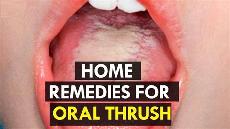 Oral thrush is a medical condition which occurs due to accumulation or ...