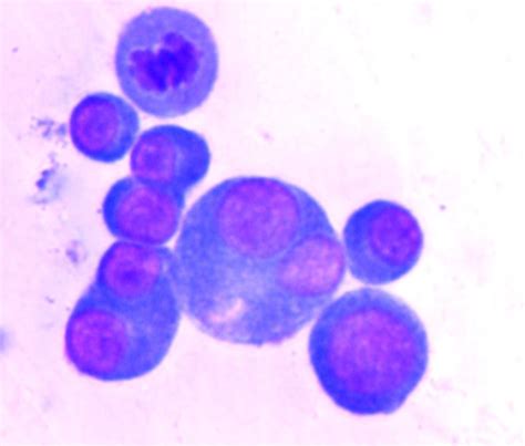 Pleural fluid cytology- Many atypical plasma cells with | Open-i