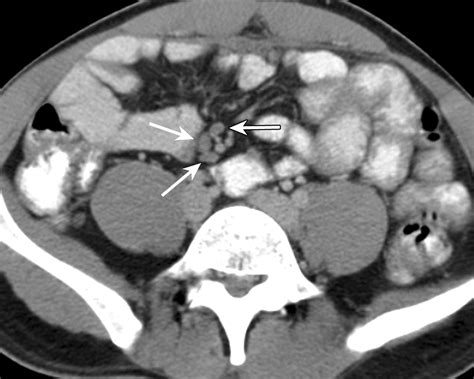 Mesenteric Lymph Nodes Radiology