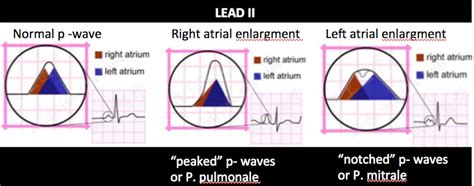 Atrial Enlargement On Ekg