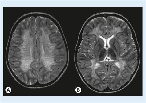 MRI in juvenile metachromatic leukodystrophy. (A) The central white ...