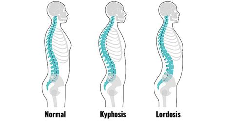 Hyperlordosis - Signs, Causes and Corrective Exercises