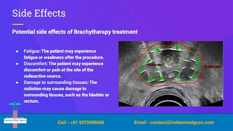 PPT - Brachytherapy_slidesgpt PowerPoint Presentation, free download ...