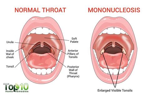 Home Remedies to Treat Mononucleosis | Top 10 Home Remedies