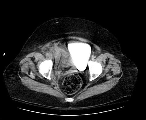 Retroperitoneal hematoma - wikidoc