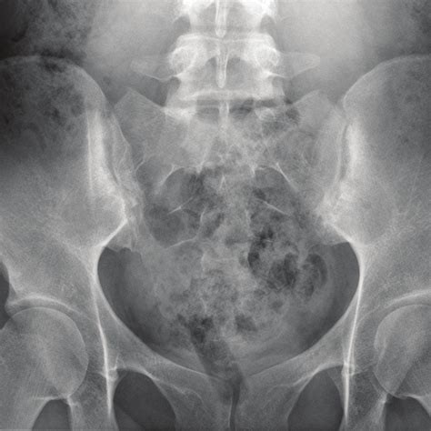 [DIAGRAM] X Ray Pelvis Diagram - MYDIAGRAM.ONLINE