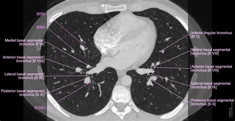 Anatomy of the lungs, mediastinum and heart in axial slice | e-Anatomy