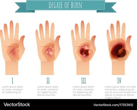 Degree skin burns flat Royalty Free Vector Image