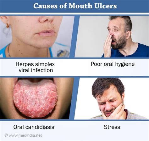 Mouth | Oral Ulcers - Causes, Symptoms, Diagnosis, Treatment and Prevention