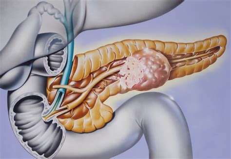 Treatment Options for Pancreatic Neuroendocrine Tumors - Endocrinology ...