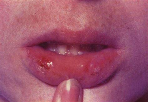 Syphilis Treatment And Risks