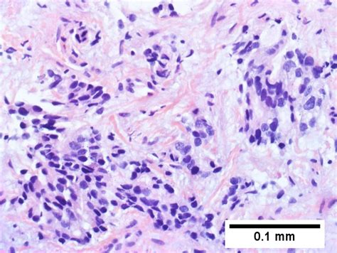 Cholangiocarcinoma - Libre Pathology