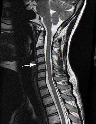 How to Read an MRI of a Neck | Normal Neck MRI