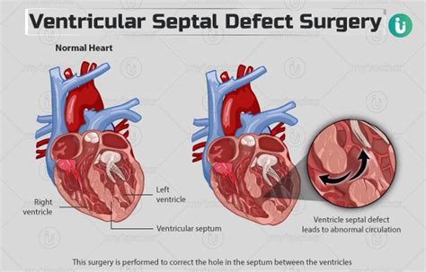 Ventricular septal defect surgery: Procedure, Purpose, Results, Cost, Price