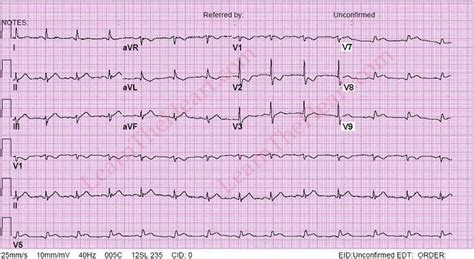 Posterior Wall MI - Posterior ECG | LearntheHeart.com