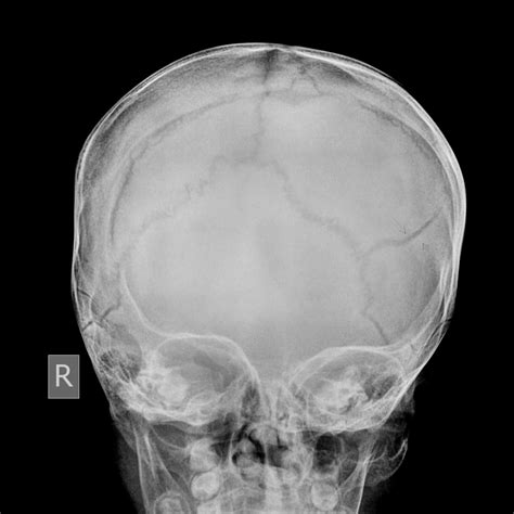 Xray Skull Fracture