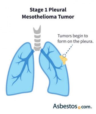 4 Stages of Mesothelioma (Cancer Progression and Impact on Symptoms)