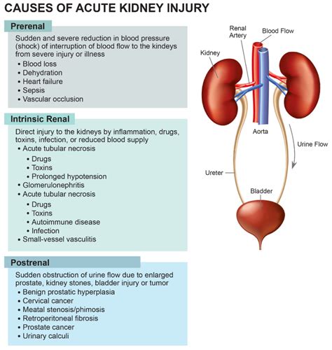 Cardiogenic Shock And Acute Kidney Injury: The Rule Rather, 50% OFF