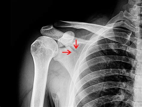 Dr Terence Moopanar | Shoulder fracture management