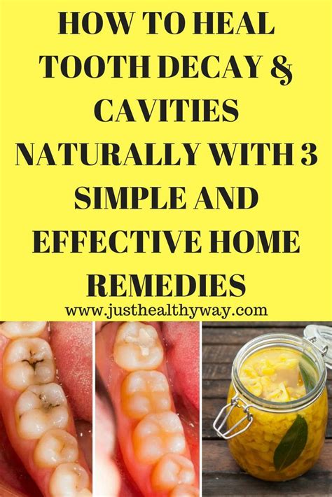 HOW TO HEAL TOOTH DECAY & CAVITIES NATURALLY WITH 3 SIMPLE AND ...